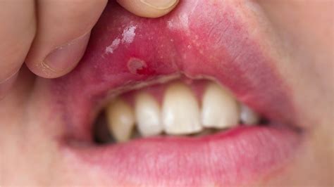 Canker Sore In Roof Of Mouth