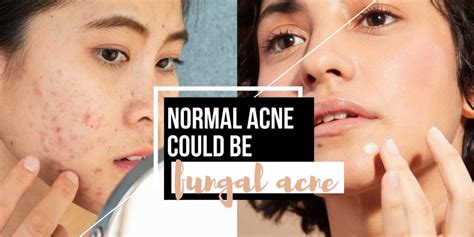 Do You Have Fungal Acne Here Are The Symptoms And How To Treat It