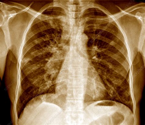 Tuberculosis Pneumonia X Ray Stock Image M2700338 Science Photo