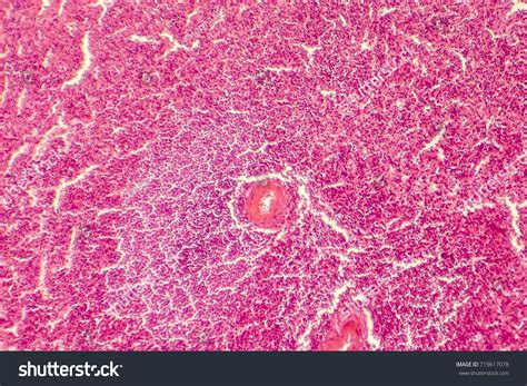 Hyaline Degeneration Splenic Artery Light Photomicrograph Stock Photo