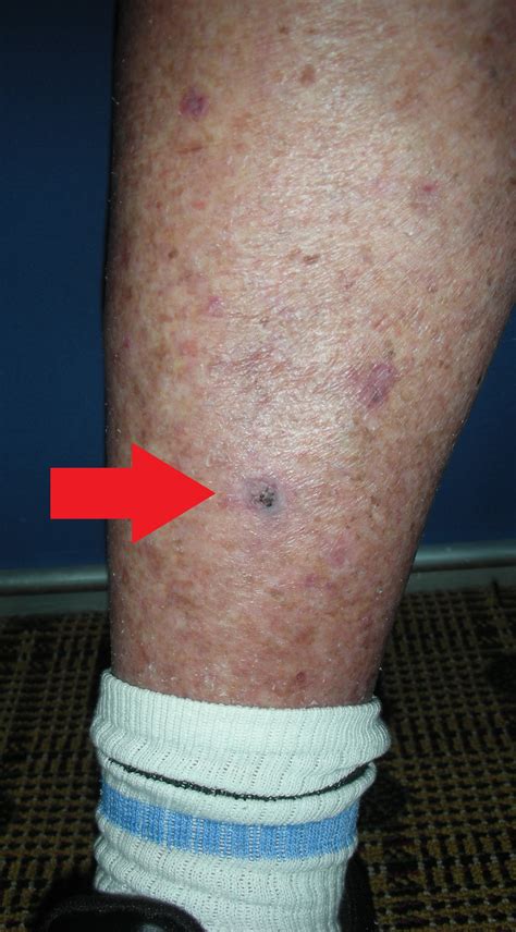 Skin Cancer Spots On Legs Therescipes Info