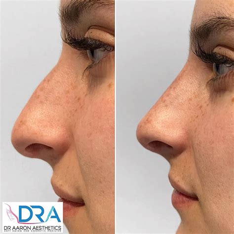 Are you seeking an indian nose job (rhinoplasty)? Dr Aaron Stanes on Instagram: "Non Surgical Rhinoplasty ...