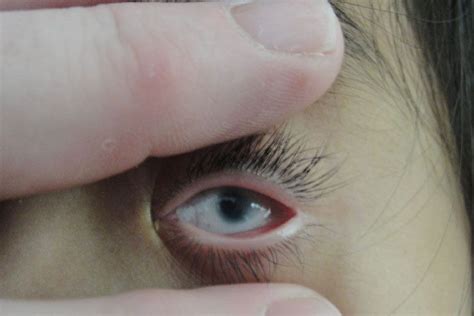 Eye twitching also known eyelid twitching is a common eye problem. Everything You Want to Know About Left Eye Twitching