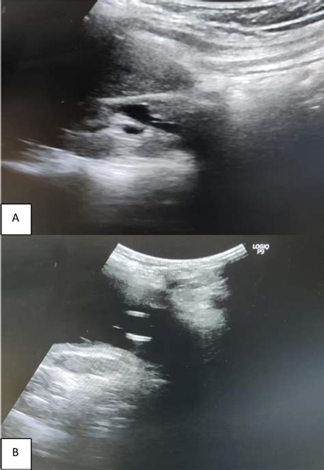 Figure 2 From A Rare Case Report On Double J Stenting In A Rare Case Antepartum Patient With