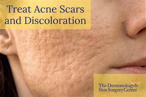 Dermatologist Recommended Treatments For Acne Scars And Discoloration
