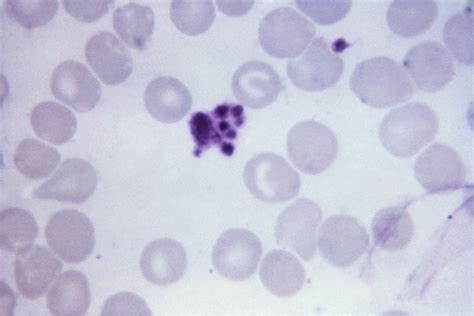 Free Picture Micrograph Platelet Artifact Mistaken Malaria Parasite