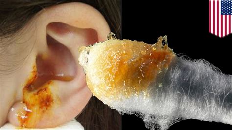 Removing Ear Wax Cleaning Ears With A Q Tip Is Bad For You Bad For