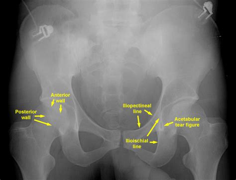 Pelvic Anatomy Xray Female Pelvis Bones And Joints X Ray Stock
