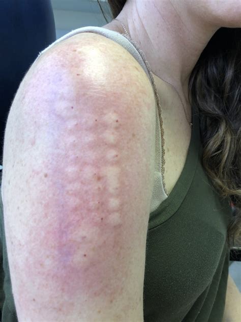 My Experience With Allergy Testing Caitlin Houston