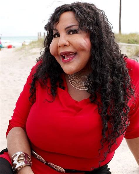 Disfigured Transgender Woman Shows Off Her New Face 7 Pics