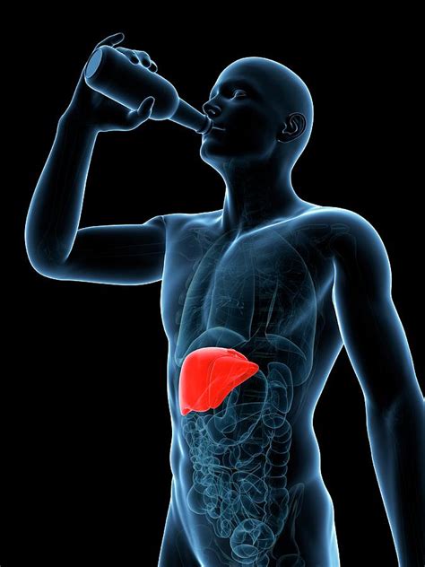 Alcoholic Liver Disease Photograph By Scieproscience Photo Library