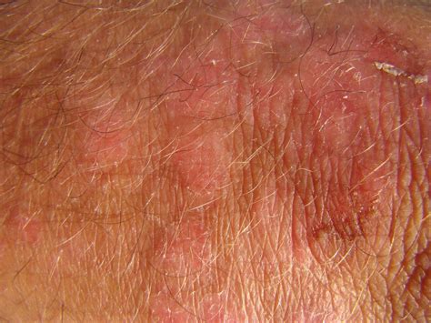How Long Does Eosinophilic Folliculitis Last The Answer