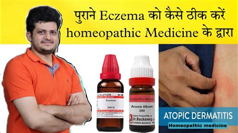 How To Cure Atopic Dermatitis Homeopathic Medicine Full Treatment