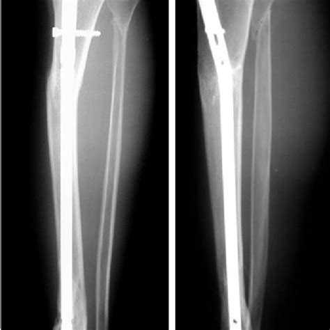 Postoperative Radiographs Of This Proximal Tibial Shaft Fracture Show