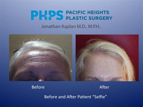 Botox Really Works Before And After Photos Plastic Surgeon San Francisco Pacific Heights