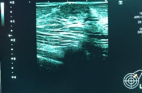 Ultrasound Of The Left Breast Showing A Well Defined Hypoechoic Solid
