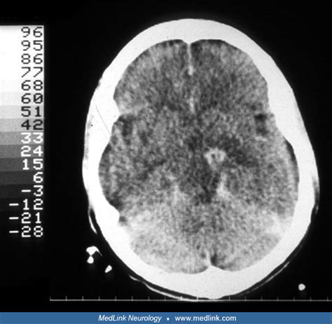 Cerebral Toxoplasmosis Medlink Neurology