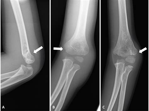 Cureus Simultaneous Open Reduction And Corrective Osteotomy For A