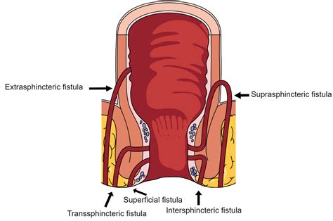 Cureus The Multidisciplinary Management Of Perianal Fistulas In Crohn