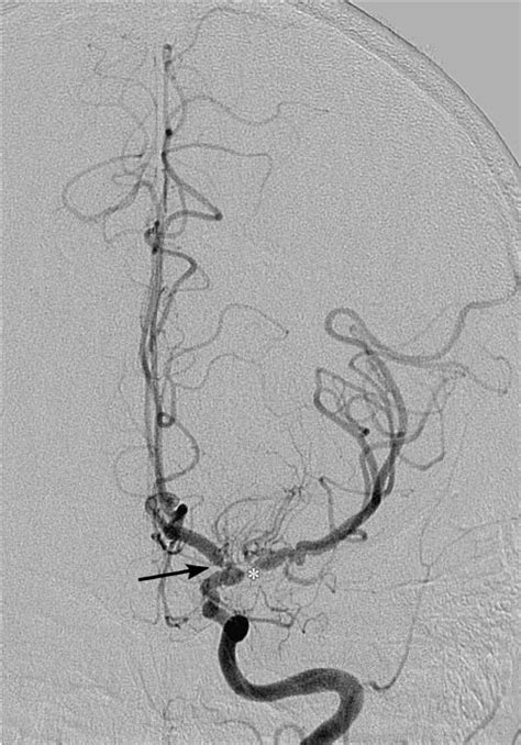 Right Temporal Artery Biopsy Showing Mild Chronic Lymphocytic