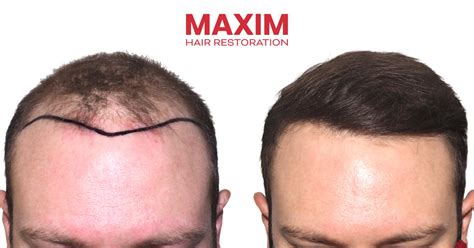 Hair Transplants And Restoration Maxim Hair Restoration