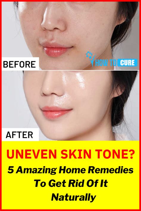 5 Simple Natural Ways To Get Rid Of Uneven Skin Tone