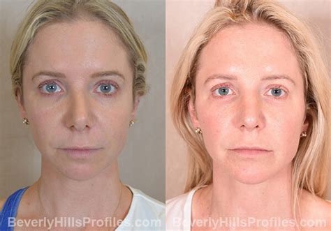 Chin Implants Before And After Photos Los Angeles