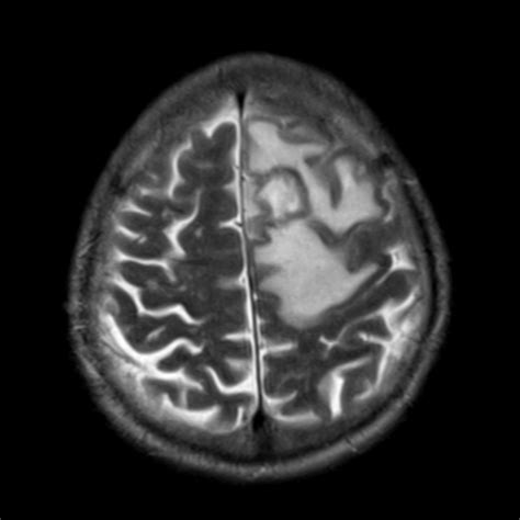 Cerebral Toxoplasmosis Pulse Md Neuroradiology Cases