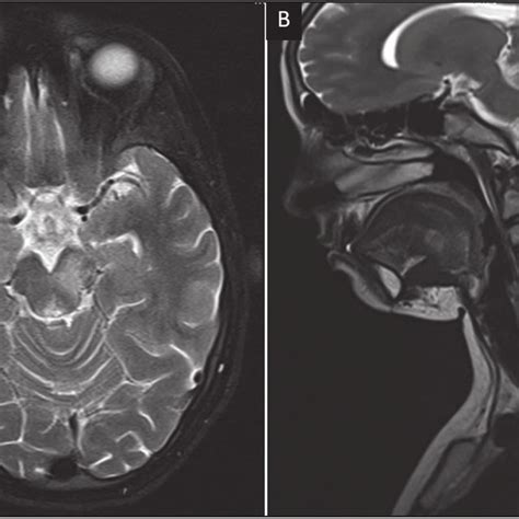 Mri Of Brain Axial T2 Weighted Sequence A Showing Ill Defined