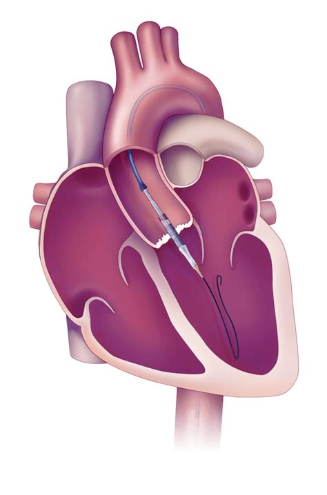 Transcatheter Aortic Valve Replacement Tavr St Clair Health