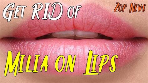 15 Tips To Get Rid Of Milia On Lips Milia On Lips Lips Hair Skin Nails