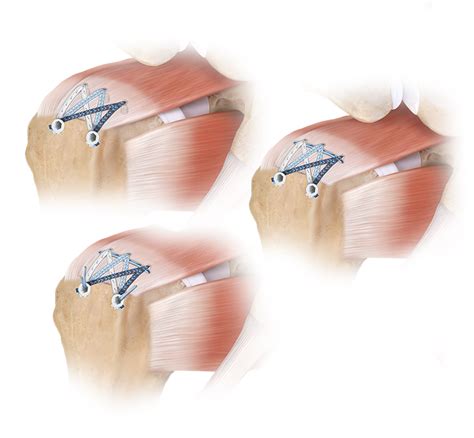 Arthrex Fibertak® Speedbridge™ Rotator Cuff Repair