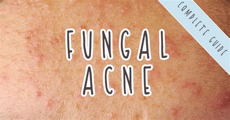 What Is Fungal Acne Fungal Acne Treatments Triggers And Safe Products