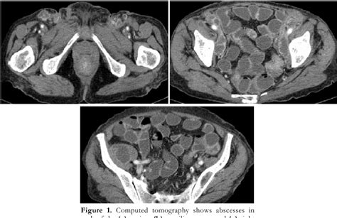 Figure 1 From Hidradenitis Suppurativa Accompanying Crohns Disease