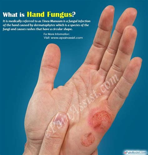 Hand Fungus Fungi Fungal Infection Plaque Psoriasis Treatment