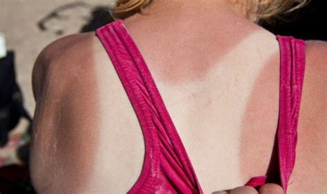 tanning advice how to turn sunburn into a tan top tips advocatehealthyu