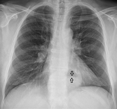 Hiatal Hernia Wikipedia