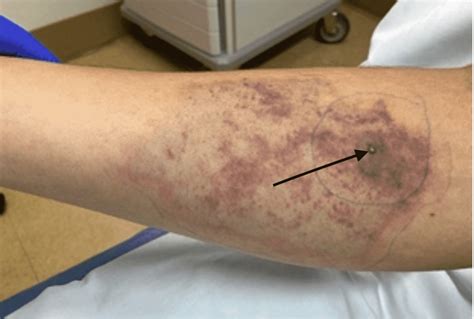 Brown Recluse Spider Chunk Leading To Coombs Damaging Hemolytic Anemia