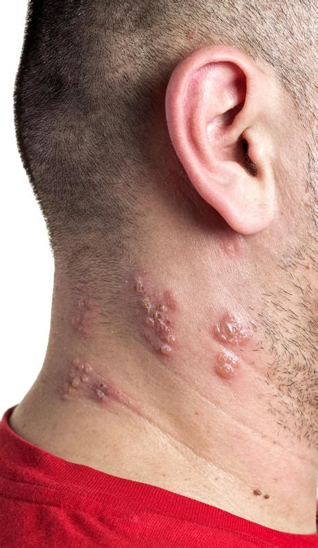 What Are The Common After Effects Of Shingles With Pictures