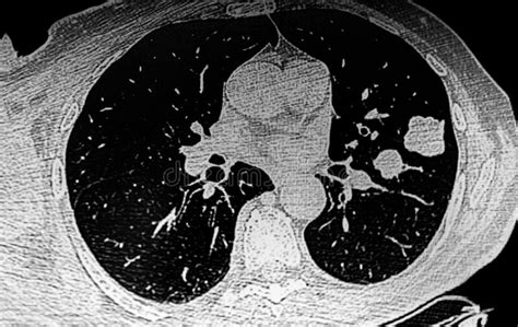 Chest Ct Scan Showing Left Lung Tumors Stock Image Image Of Medical