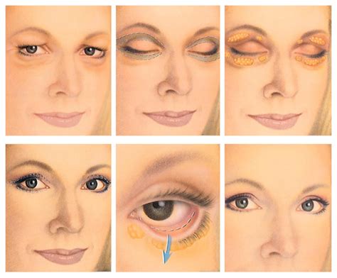 Of course, this price will depend on your prescription, as well as. Eyelid Surgery (Blepharoplasty) Jacksonville, Ponte Vedra, Fl