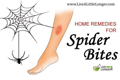5 Best Home Remedies For Spider Bites