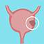 Bladder Cancer Overview And More