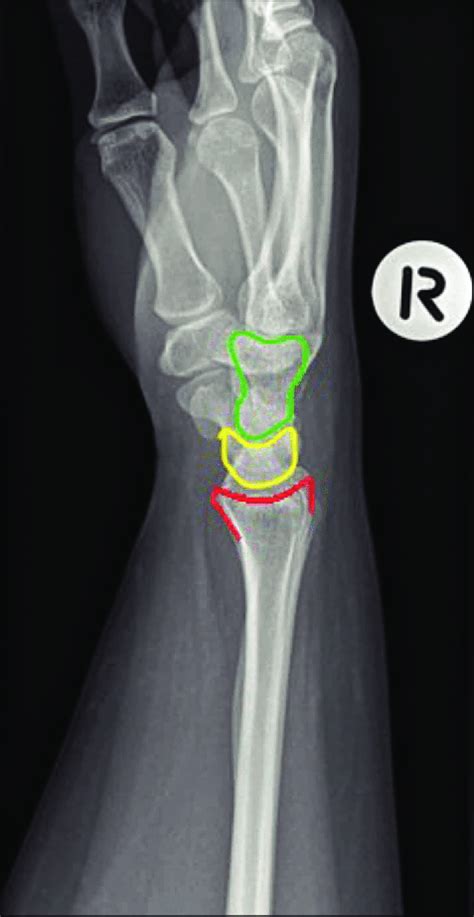 Lateral Radiograph With Normal Findings Revealing A Collinear Axis Of
