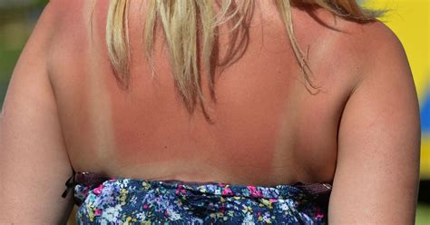 Livestrong.com offers diet, nutrition and fitness tips for a healthier lifestyle. How to treat sunburn fast: Tips if you've been caught out ...
