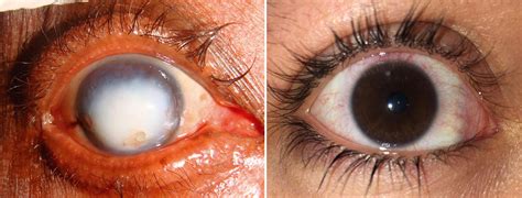 Diseases And Disorders Of The Cornea Doctor Eye Institute