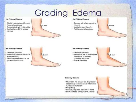 Edema Rating Scale