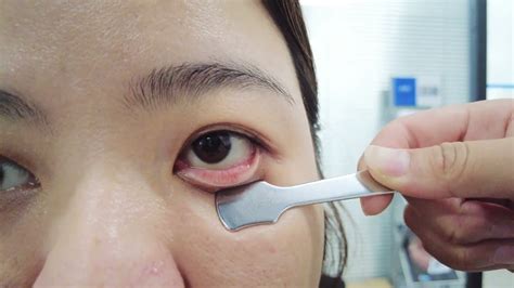 How To Flip Eyelids Inside Out Dry Eye Treatment Meibomian Glands
