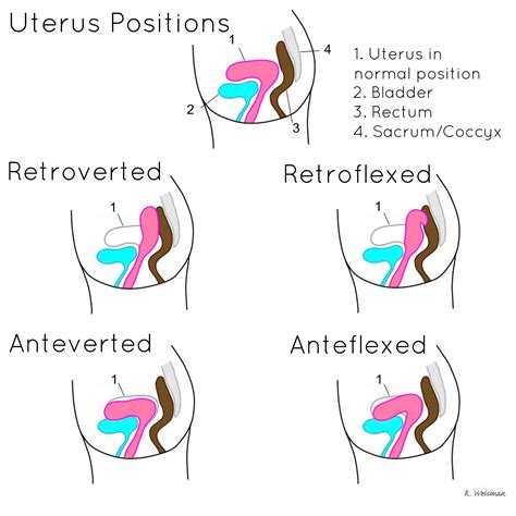 Manual Displacement Of Uterus During Cpr