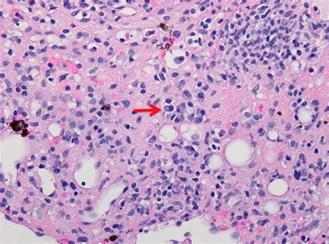 An Investigation Of Biopsy Proven De Novo Autoimmune Hepatitis After